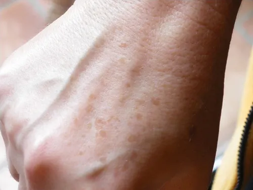 ¿Qué podemos hacer con manchas y pecas en las manos?