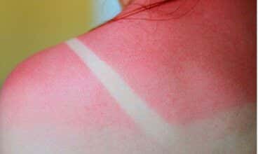 ¿Cómo tratar la piel quemada por el sol?