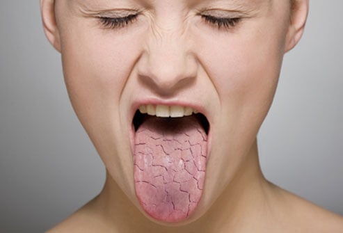 Cómo eliminar la sensación de la boca seca: 4 remedios naturales
