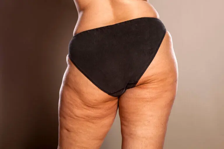 Tips sencillos para eliminar la celulitis