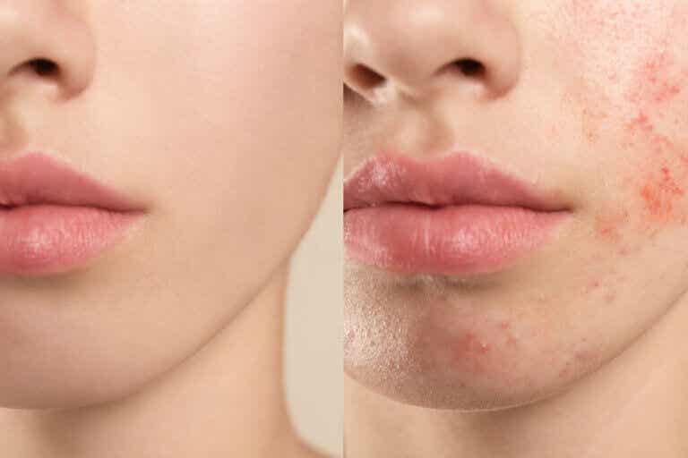 Cómo eliminar las marcas del acné con remedios naturales