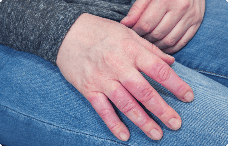 Angeschwollene Finger