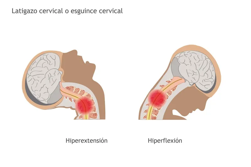 latigazo cervical: síntomas