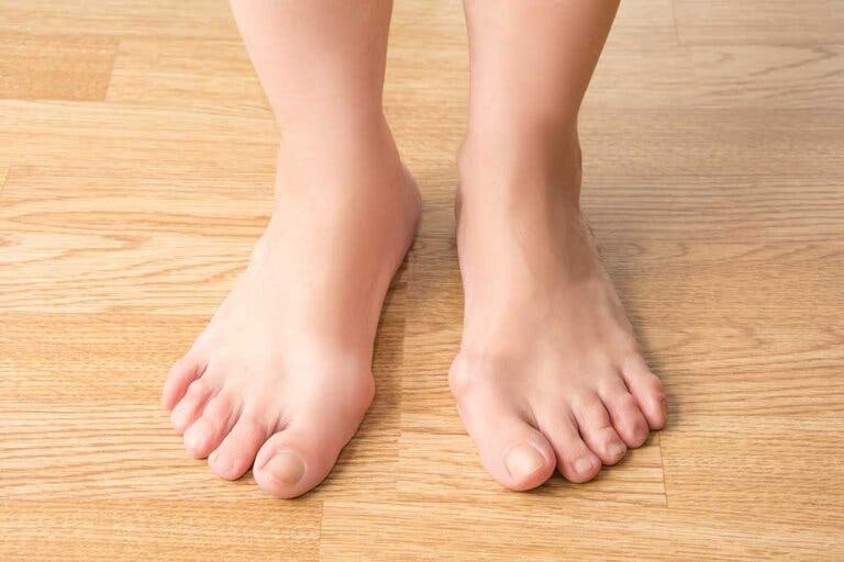 ¿Por qué se forman los juanetes?