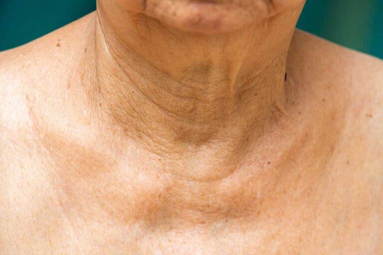 Remedios para atenuar las arrugas del cuello