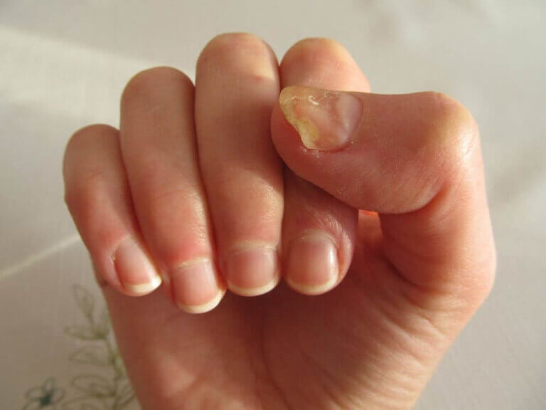 Tratamiento de las principales enfermedades de las uñas