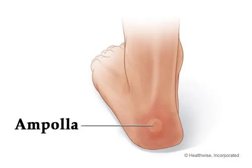 Cómo evitar y tratar correctamente las ampollas