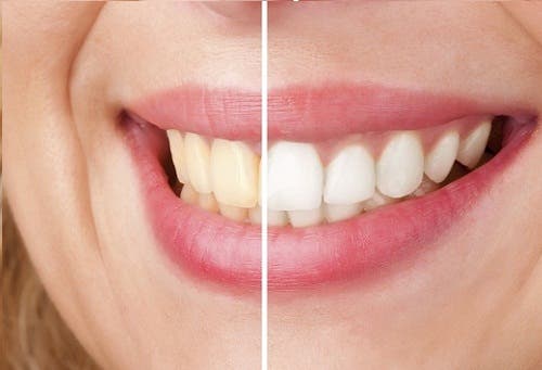Cómo blanquear los dientes con aceite de coco, cúrcuma y arcilla