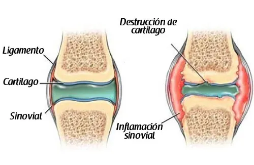 ¿Es posible prevenir el dolor de cartílagos?