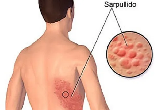 Cómo tratar naturalmente la culebrilla o herpes zóster