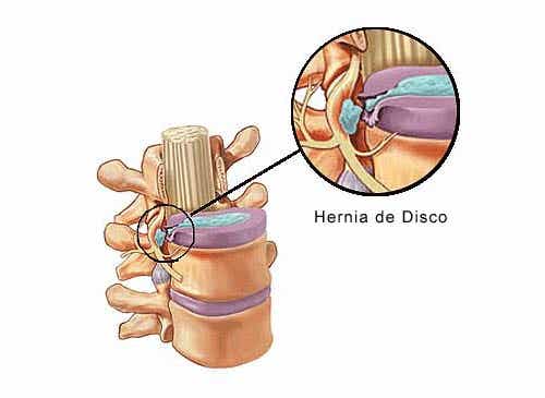 Cómo prevenir y tratar la hernia discal