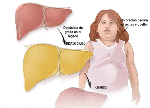 Grasa en el hígado: ¿Qué síntomas presenta?