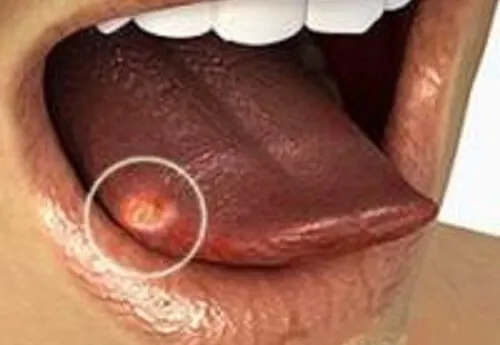Lengua blanca: causas y soluciones