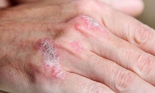 Tratamientos naturales para la psoriasis