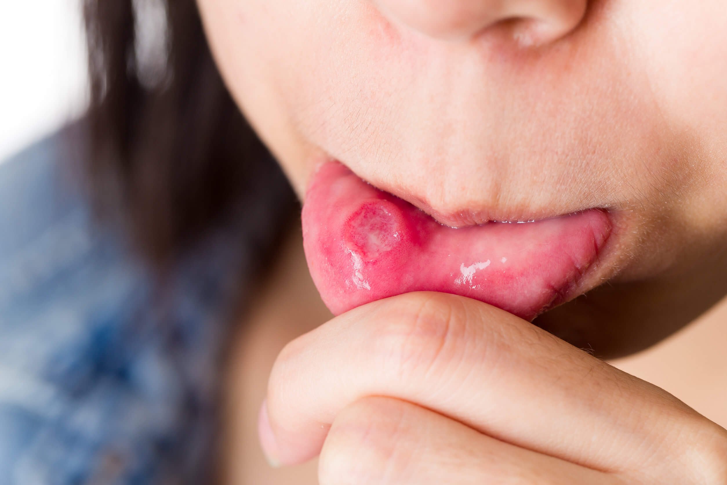 Mukozelen - Läsion auf der Zunge