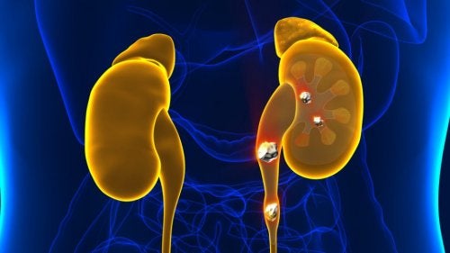 ¿Hay infusiones que ayuden a disolver cálculos renales?