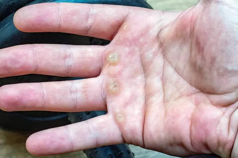 Cómo tratar naturalmente los callos