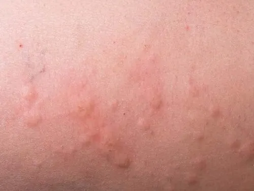 Piel con sarpullido