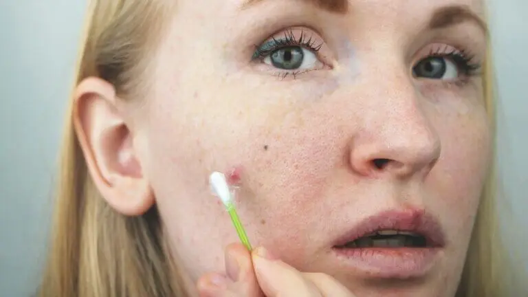 13 remedios caseros para los forúnculos