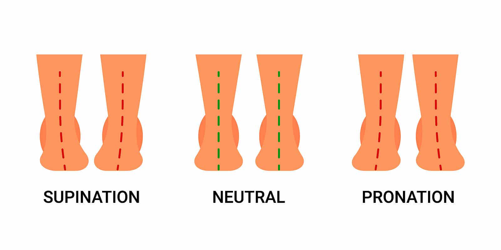 Supinación y pronación son anomalías de la pisada.