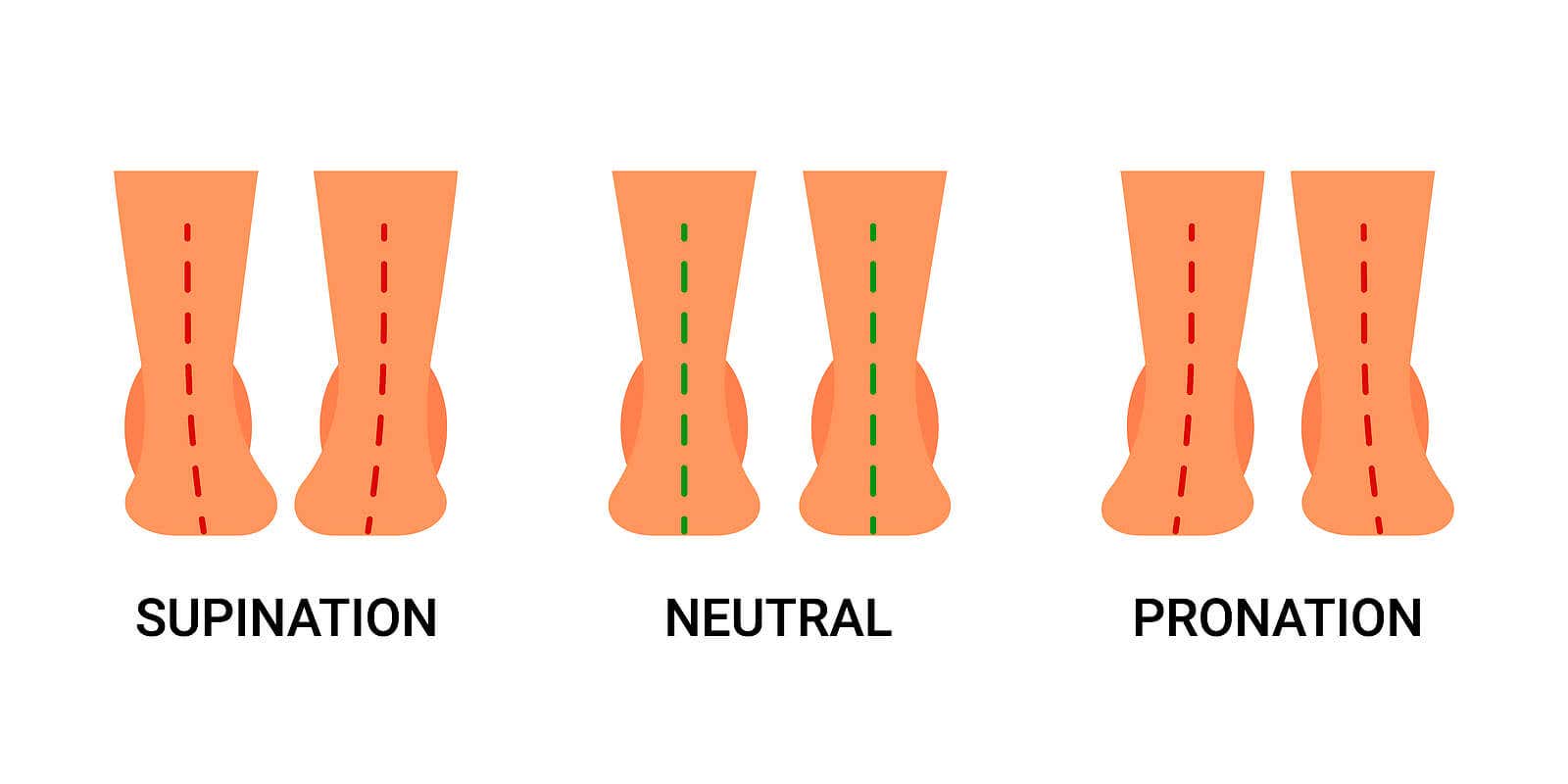 Supinación y pronación son anomalías de la pisada.