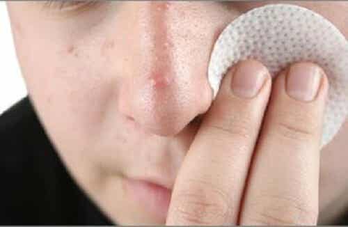 Tratar el acné cuando su origen es hormonal