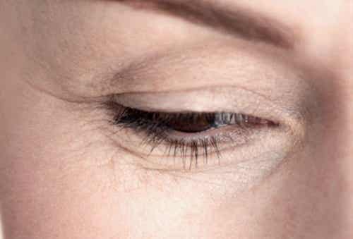 Ojos con arrugas por envejecimiento prematuro