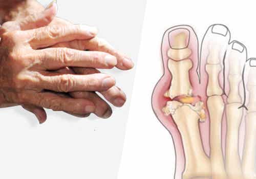 Artritis: tipos, tratamientos y recomendaciones