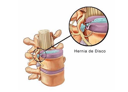 Síntomas de una hernia discal
