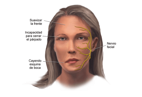 Cómo prevenir y tratar la parálisis facial