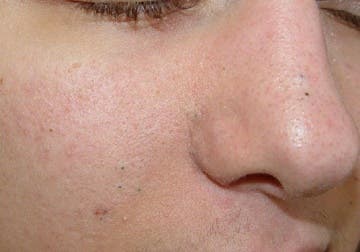 Mascarillas naturales para los puntos negros