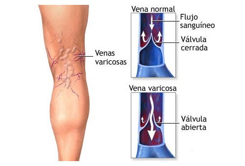 Plantas medicinales para tratar las varices
