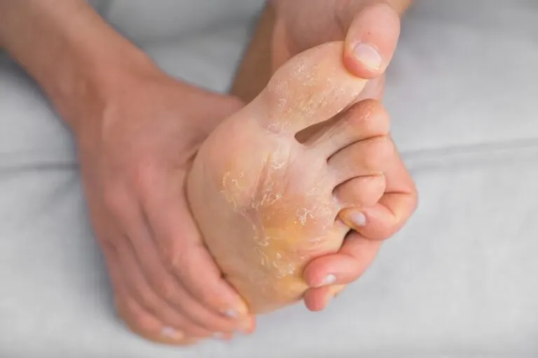 15 consejos para prevenir y eliminar los hongos en los pies