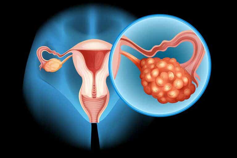 Cáncer de ovario: todo lo que debes saber