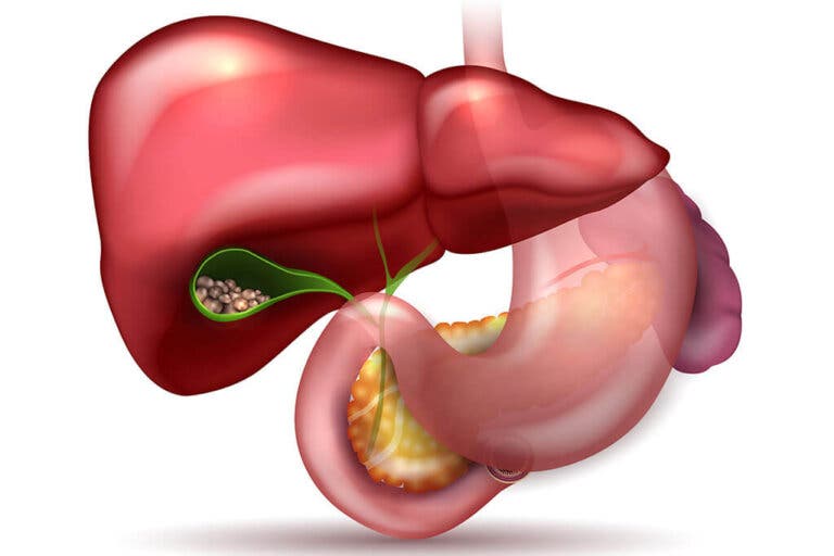 Plantas medicinales para prevenir los cálculos biliares