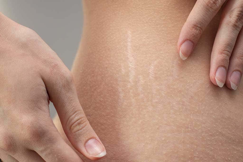Rozstępy wymagające pielęgnacji skóry po porodzie.