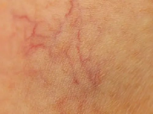 9 Formas de prevenir naturalmente las 'arañitas'