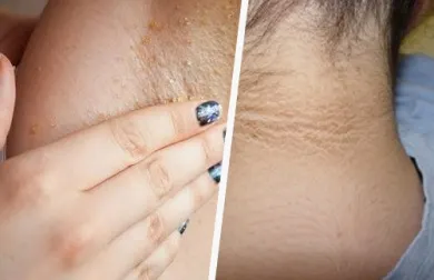 ¿Es posible blanquear las axilas y el cuello naturalmente?