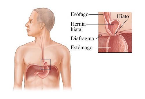 Hernia de hiato