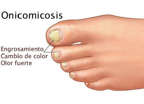 Hongos en las uñas u onicomicosis