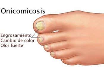 Onicomicosis: cuando los hongos están en las uñas
