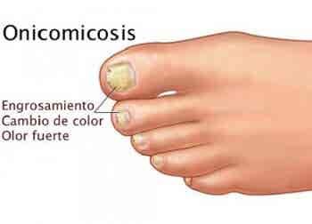 Onicomicosis: cuando los hongos están en las uñas
