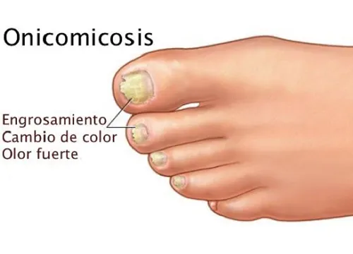 Hongos en las uñas u onicomicosis