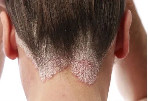 Remedios caseros para la caspa y la seborrea