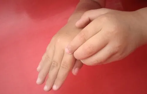 Picazón insistente en los dedos. ¿A que se debe?