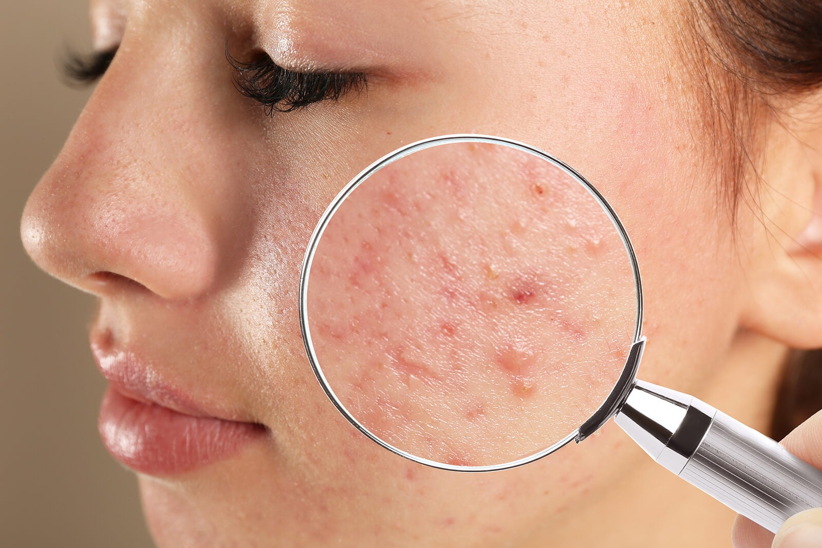Acercamiento de piel con acné