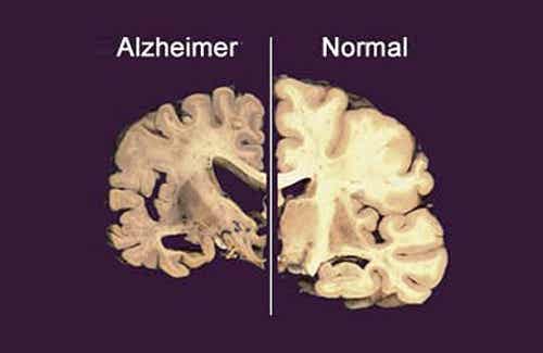 ¿La falta de sueño está relacionada con la aparición de alzhéimer?
