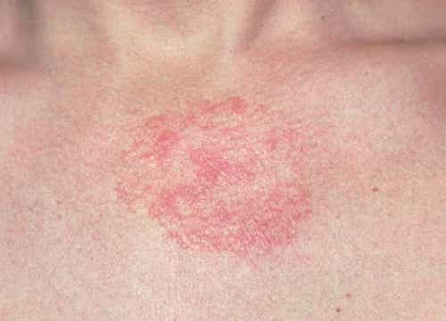5 remedios caseros para la dermatitis