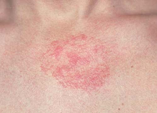 Baños caseros para la dermatitis: ¿son eficaces?