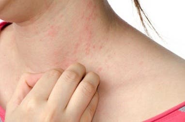 Por qué nos pica el cuerpo y cómo evitar rascarse